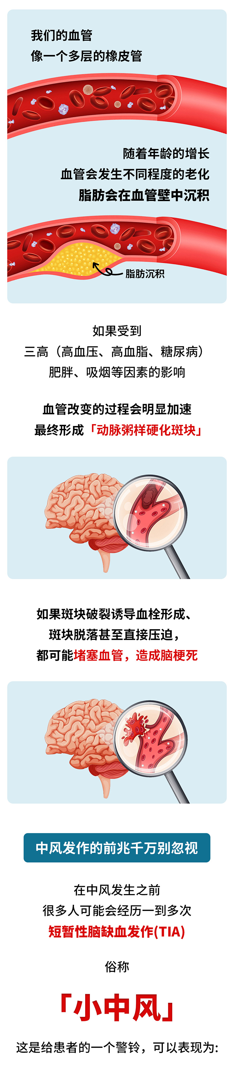 中風(fēng)的5個(gè)前兆，盡早發(fā)現(xiàn)能救命_02.jpg